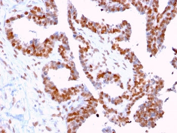 IHC staining of FFPE human prostate carcinoma with DMC1 antibody (clone 2H12/4). HIER: boil tissue s