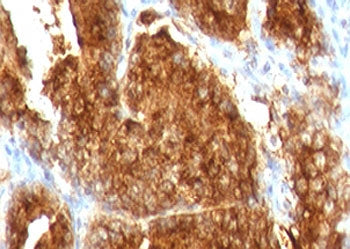 IHC testing of FFPE human prostate carcinoma with AMACR antibody (clone 2MACR-1). Required HIER: ste