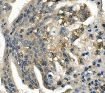 IHC staining of FFPE human rectal cancer with LDL Receptor antibody. HIER: boil tissue sections in p