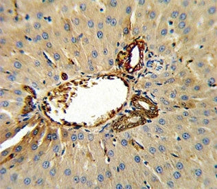 Annexin V antibody IHC analysis in formalin fixed and paraffin embedded human hepatocarcinoma.