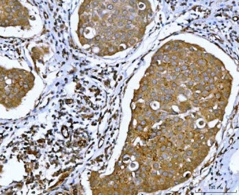 IHC staining of FFPE human breast cancer tissue with Ataxin-2 antibody. HIER: boil tissue sections i