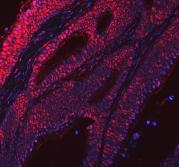 Immunofluorescent staining of FFPE human colorectal cancer tissue with RSRC2 antibody (red) and DAPI
