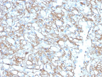 IHC testing of FFPE lung carcinoma with biotin-conjugated PD-L1 antibody (clone PDL1/2746). HIER: bo