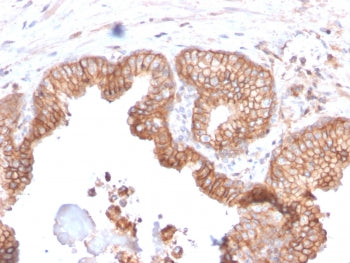 IHC staining of FFPE human prostate carcinoma with CD47 antibody (clone CD47/2937). HIER: boil tissu
