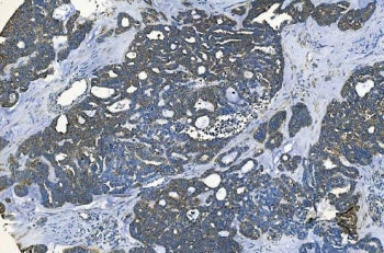 IHC staining of FFPE human ovarian cancer with GABARAP antibody. HIER: boil tissue sections in pH8 E