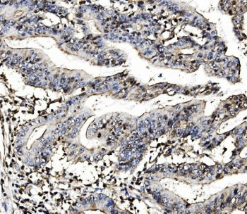 IHC staining of FFPE human rectal cancer with MORC3 antibody. HIER: boil tissue sections in pH8 EDTA
