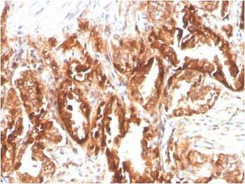 IHC staining of FFPE human prostate carcinoma with biotinylated CD47 antibody (clone CD47/2937). HIE