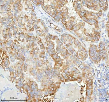 IHC staining of FFPE human thyroid papillary carcinoma tissue with HAGH antibody. HIER: boil tissue 