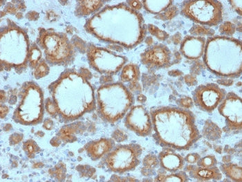 IHC staining of FFPE human thyroid carcinoma with TPO antibody. HIER: boil tissue sections in pH 9 1