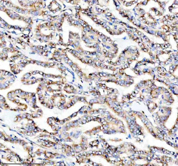 IHC staining of FFPE human thyroid cancer tissue with PRKCH antibody, HRP-secondary and DAB substrat