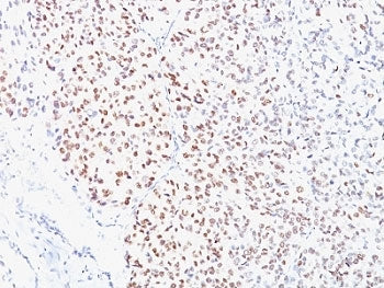 IHC analysis of formalin-fixed, paraffin-embedded human melanoma stained with MITF antibody (clone C