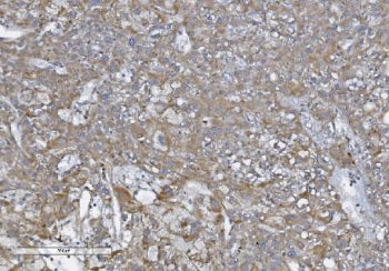 IHC staining of FFPE human liver cancer with NOD1 antibody. HIER: boil tissue sections in pH8 EDTA f