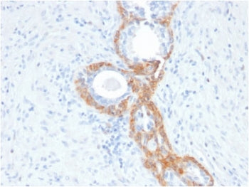 IHC testing of FFPE human prostate cancer with recombinant Basic Cytokeratin antibody (clone rKRTH/2