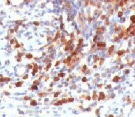 IHC testing of FFPE human lymphoma and CD79a antibody (clone CDLA79a-1). HIER: formalin-fixed tissue