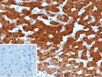 IHC staining of FFPE human hepatocellular carcinoma tissue with Arginase 1 antibody (clone ARG1/9448