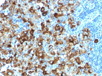 IHC testing of FFPE human melanoma with recombinant gp100 antibody (clone PMEL/1825R). Required HIER