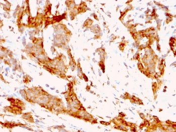 IHC analysis of formalin-fixed, paraffin-embedded human breast carcinoma tissue stained with GRP94 a