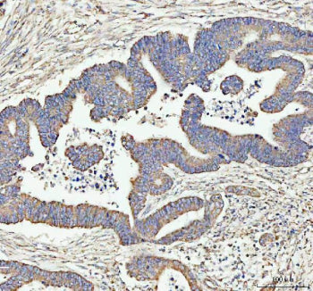 Immunohistochemical staining of ARHGEF12L using anti-ARHGEF12L antibody. ARHGEF12L was detected in a
