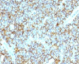IHC testing of FFPE human Ewing's sarcoma and CD99 antibody (clone CDLA99). Staining of formalin-fix