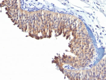 IHC testing of human bladder carcinoma with Cytokeratin 10 antibody (clone LH2). HIER: boil tissue s