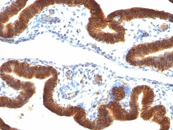 Formalin-fixed, paraffin-embedded human ovarian carcinoma stained with anti-EpCAM antibody (clone SP