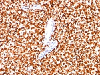 IHC: Formalin-fixed paraffin-embedded human Ewing's sarcoma stained with NKX2.2 antibody (clone SPM5