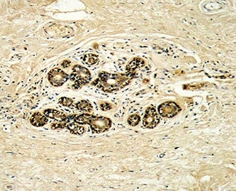 IHC analysis of FFPE human breast carcinoma with HER3 antibody
