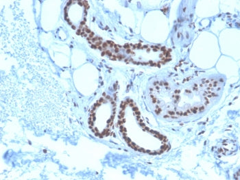 IHC staining of FFPE human basal cell carcinoma with Nucleophosmin antibody (clone NPM1/3285). HIER: