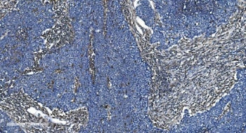IHC staining of FFPE human lung cancer with GNG2 antibody. HIER: boil tissue sections in pH8 EDTA fo