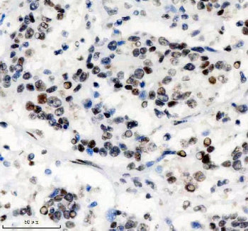 IHC staining of FFPE human stomach cancer tissue with PHF8 antibody, HRP-secondary and DAB substrate