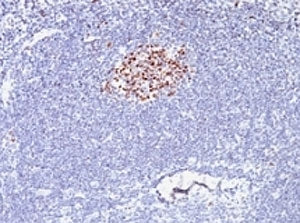 IHC testing of formalin-fixed, paraffin-embedded human lymphoma stained with anti-Bcl6 antibody (clo