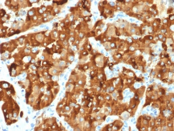 IHC testing of FFPE human renal carcinoma with AMACR antibody. Required HIER: steam section in pH6 c