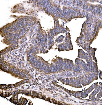 IHC staining of FFPE human rectal cancer tissue with HIP1R antibody. HIER: boil tissue sections in p