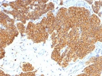 IHC: Formalin-fixed, paraffin-embedded human parathyroid stained with Parathyroid Hormone antibody (
