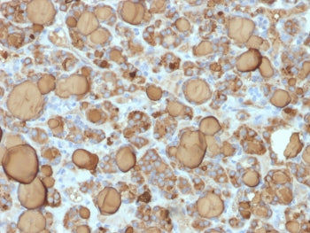 IHC testing of FFPE human thyroid carcinoma with recombinant Thyroglobulin antibody (clone TGB/1968R
