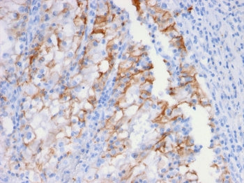 IHC testing of FFPE human renal cell carcinoma and Cadherin 16 antibody. Staining of formalin-fixed 