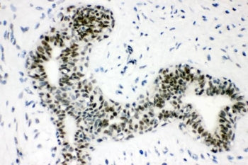 IHC staining of FFPE human breast cancer with SUMO1 antibody. HIER: boil tissue sections in pH8 EDTA