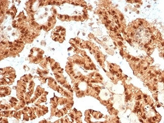 IHC staining of FFPE human renal cell carcinoma tissue with recombinant STAT6 antibody (clone STAT6/