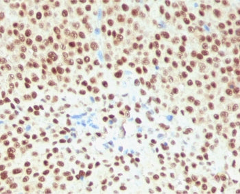 IHC staining of FFPE human melanoma tissue with recombinant SOX10 antibody (clone SBX10-2R). Require
