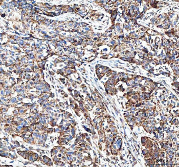 Immunohistochemical staining of FFPE human bladder urothelial carcinoma tissue with MUT antibody, HR
