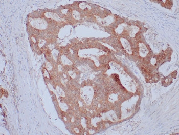 IHC staining of FFPE human colon adenocarcinoma with EpCAM antibody (clone Ber-EP4). HIER: boil tiss