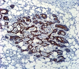 TGFB2 antibody immunohsitochemistry analysis in formalin fixed and paraffin embedded human colon car
