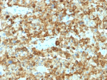 IHC testing of human melanoma with PMEL17 antibody (clone PMEL/2037). Required HIER: boil tissue sec