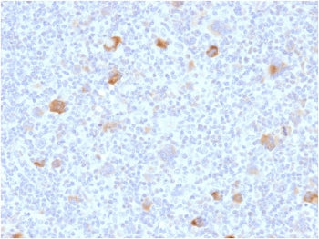 IHC staining of FFPE human Hodgkin's lymphoma with Bcl-X antibody (clone BCL2L1/2406). HIER: boil ti