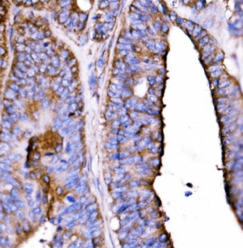 IHC staining of FFPE human rectal cancer tissue with 5HT1B antibody. HIER: boil tissue sections in p