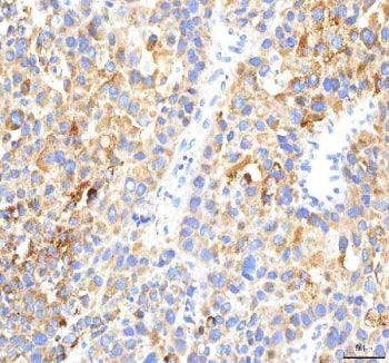 IHC staining of FFPE human liver cancer tissue with HEPACAM2 antibody. HIER: boil tissue sections in