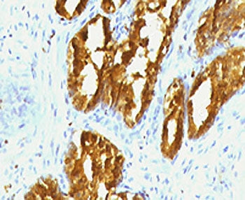IHC testing of human prostate carcinoma with PSAP antibody (clone PSPN1-1). FFPE testing requires se