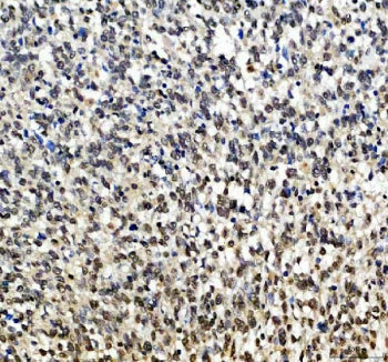 IHC staining of FFPE human melanoma tissue with SOX10 antibody. HIER: boil tissue sections in pH8 ED