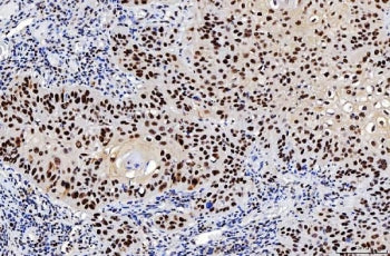 IHC staining of FFPE human laryngeal squamous cell carcinoma tissue with Flap endonuclease 1 antibod