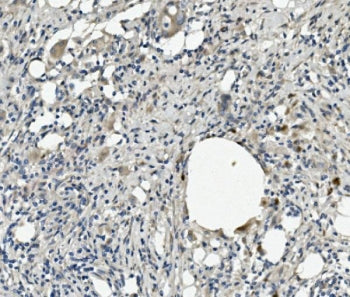 IHC staining of FFPE human rectal cancer with Kallistatin antibody. HIER: boil tissue sections in pH